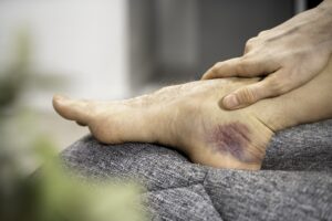 	
A person holds their foot, which has a large, dark purple bruise and swelling near the ankle, indicating an injury—highlighting situations where learning how hemp helps with inflammation could be beneficial.